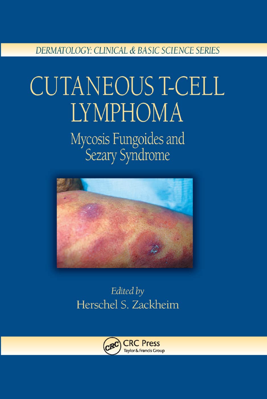 Cutaneous T-Cell Lymphoma (Dermatology cover