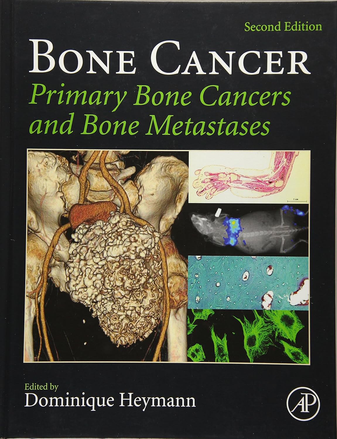Bone Cancer cover