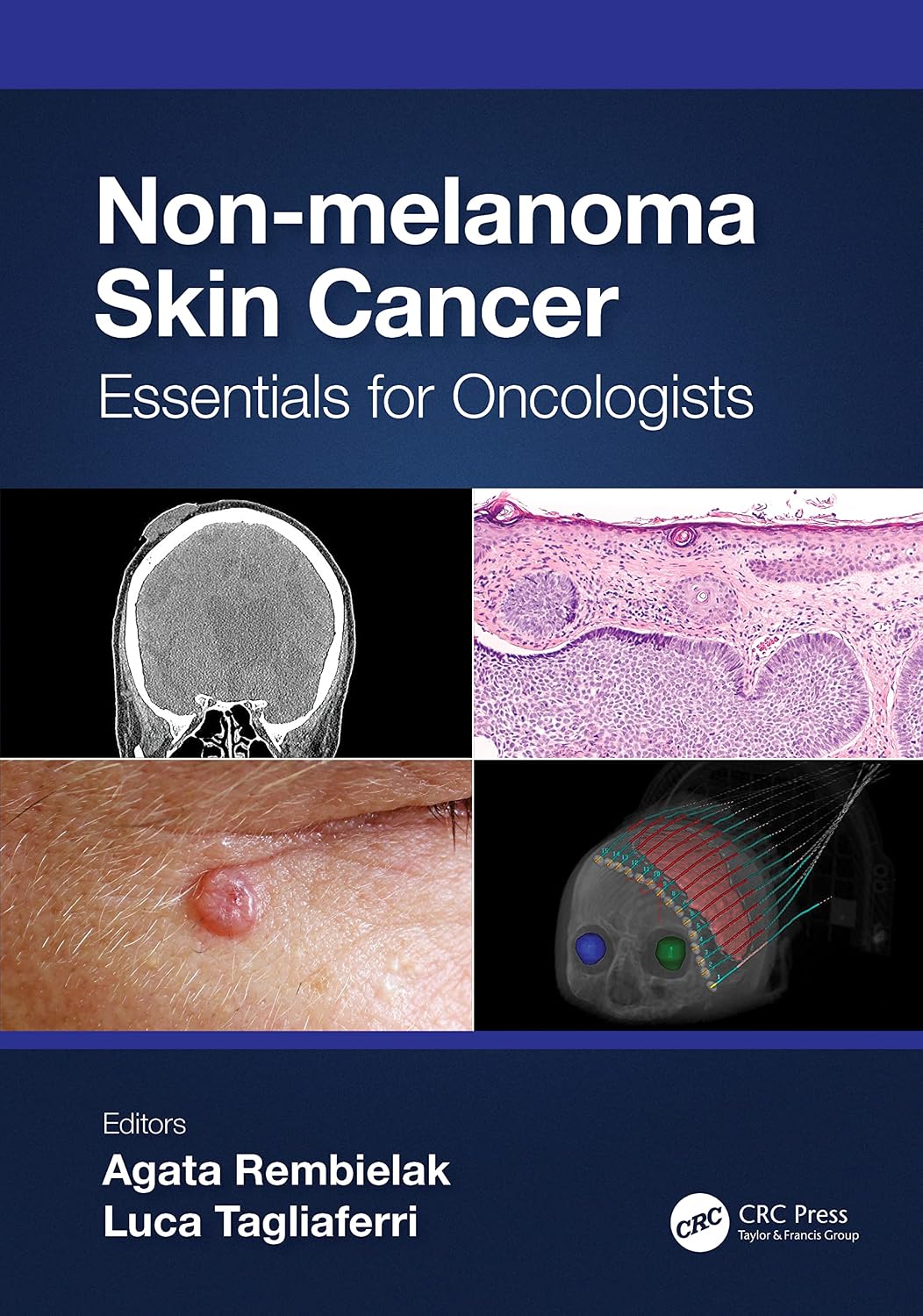 Non-Melanoma Skin Cancer cover