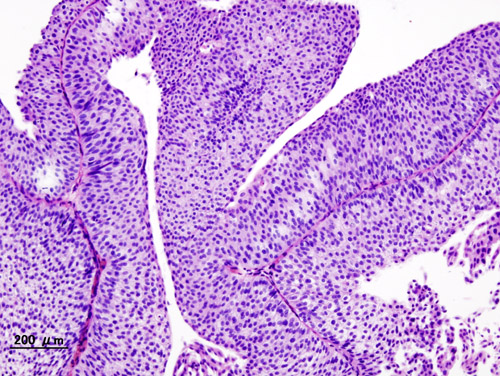 Wikimedia 10 Bladder Cancer