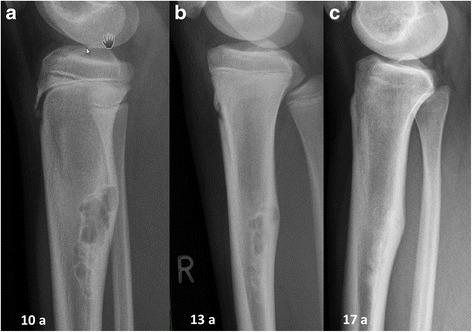 Wikimedia 11 Bone Cancer