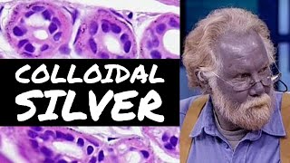 Argyria: blue skin from colloidal silver under the microscope thumbnail